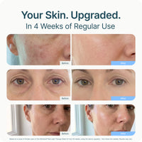 Red-Light Therapy Face Mask
