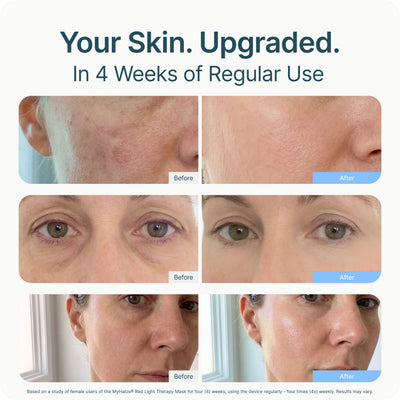 Red-Light Therapy Face Mask
